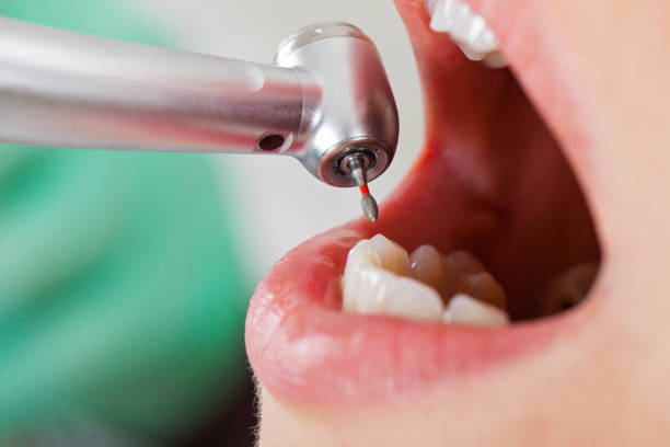 Best Emergency Wisdom Tooth Extraction in East Oakdale, CA